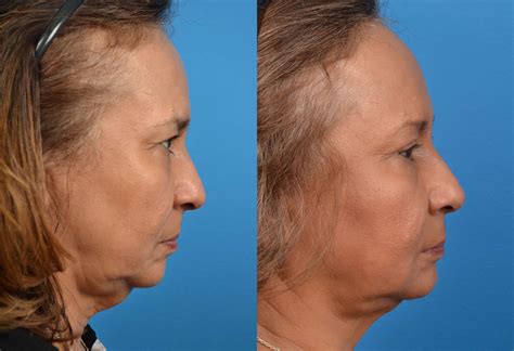 Patient 122406473 Laser Assisted Weekend Neck Lift Before And After