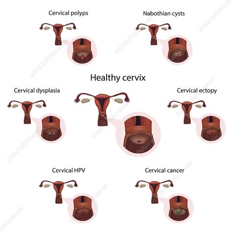 Cervical Diseases And Healthy Cervix Illustration Stock Image F