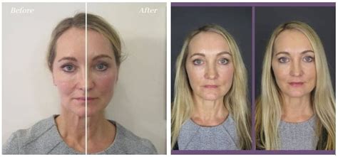 Non Surgical Mid Face Lift Using Dermal Fillers Fillers Face