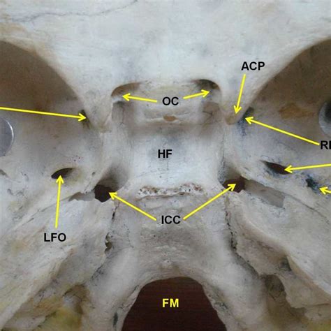 Photograph Of The Middle Cranial Fossa Showing Duplicated Foramen