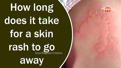 Allergic rhinitis will not go away but you can live better with it. How long does it take for a skin rash to go away | Health ...