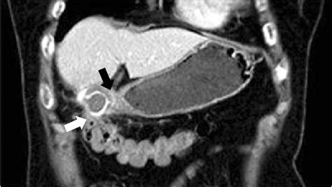 Abdominal Dynamic Ct Scan It Showed Swelling And Fatty Infiltration