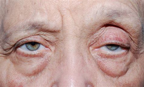 Blepharoptosis Eyewiki