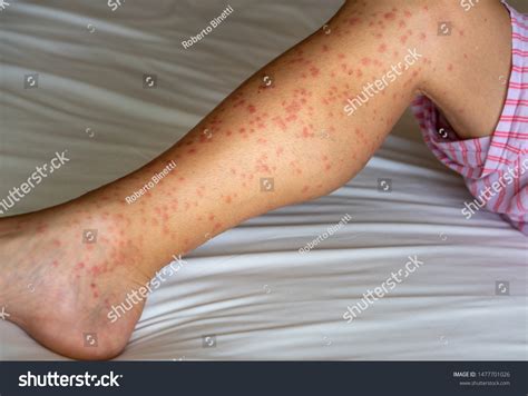 Papular Urticaria Over Royalty Free Licensable Stock Photos Shutterstock