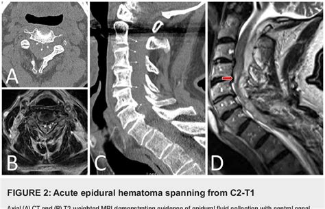 Figure 2 From Spontaneous Spinal Epidural Hematoma Associated With