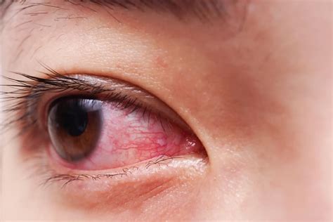 Eye Redness Causes And Treatment What You Can Do