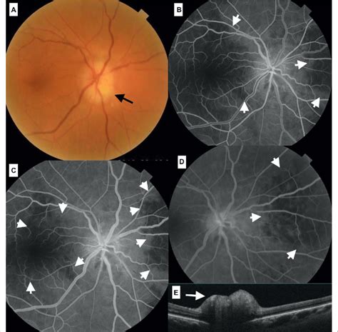 Case 4 Pale Disc Swelling Of The Optic Disc Is Noted In The Right