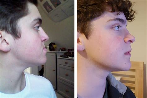 Before And After Maxillofacial Surgery And Mentoplasty One Year