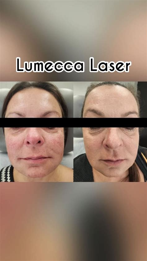 Lumecca Laser — Dr Jessica Wu