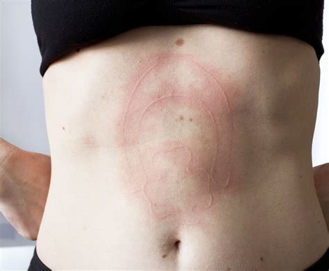 How Doing An Elimination Diet Can Help Heal Your Dermatographia Skintome