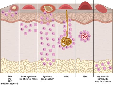 Overview Of Neutrophilic Biology Pathophysiology And Classification