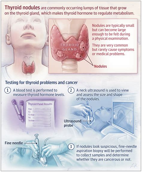 Thyroid Nodules Endocrinology Jama Otolaryngologyhead And Neck