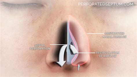 Perforated Septum Repair Specialist Dr Jason Hamilton Md How Does A Septal Perforation