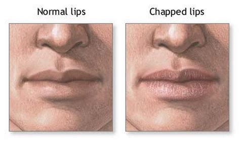 Chapped Lips Causes Symptoms Diagnosis Treatment Remedies
