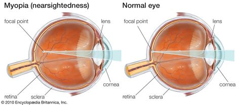 Nearsighted Vision What Are The 2 Main Causes Of Myopia Eyeviser