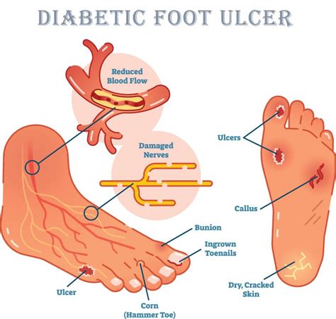 diabetic foot problems know what happens to your feet and legs due to diabetes