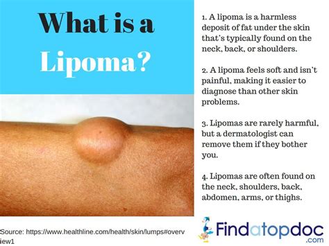 A Lipoma Is A Growth Of Fatty Tissue That Slowly Develops Under Your