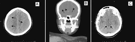 Computed Tomography Ct Of The Head Showing Bilateral Subacute