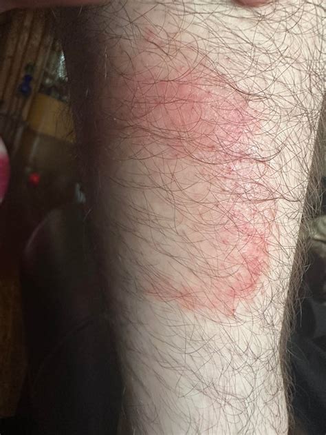 My Sister Has A Mystery Rash Can You Help Us Diagnose Before She Has