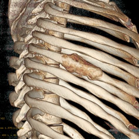 Rib Fibrous Dysplasia Associated With Aneurysmal Bone Cyst Eurorad