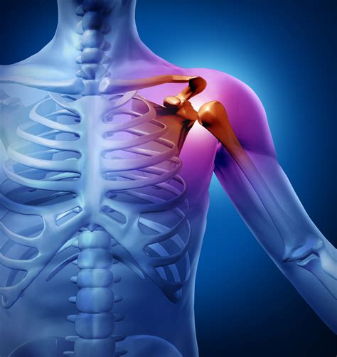 Separated Shoulder India Pdf Ppt Case Reports Symptoms Treatment