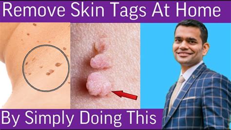 remove skin tags home remedies to remove skin tags dr vivek joshi youtube