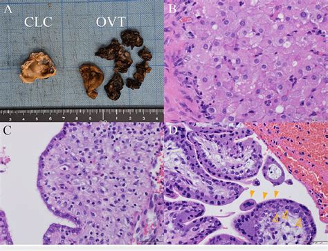 Pathological Findings A Macroscopic View Of Resected Specimens The