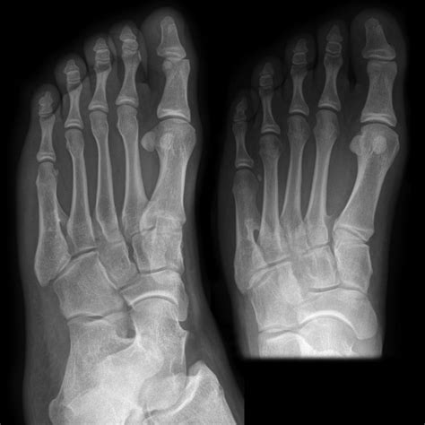 Osteochondroma Of The 5th Metatarsal Image