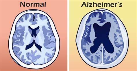 Early indications of Alzheimer's you ought to search for