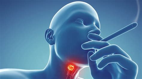 Cancer Of The Throat The Peak Onset Of Throat Cancer Is About Age 64