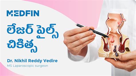 Laser Piles Treatment Pre And Post Surgical Care లేజర్ పైల్స్ చికిత్స Youtube