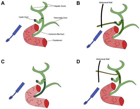 Technical Aspects Of Bile Duct Evaluation And Exploration Surgical