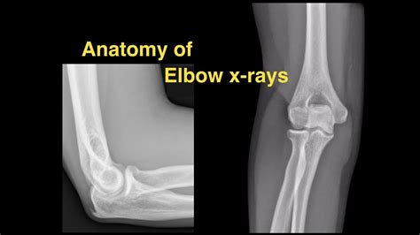 Anatomy Of Elbow X Rays Youtube