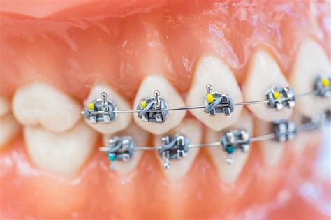 Customized Braces & Orthodontic Treatment For Adults and Children ...