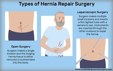 Learn About Six Types Of Hernia Southlake General Surgery