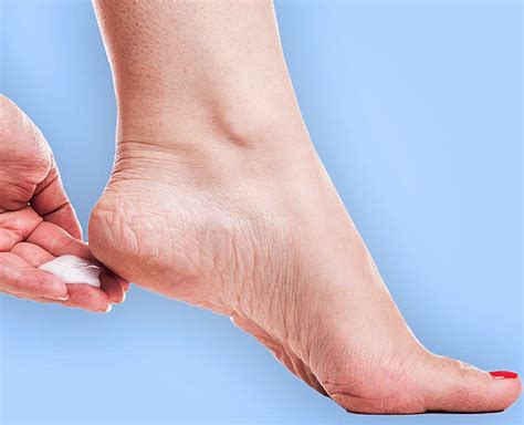 Have Cracked Heels These 9 Home Remedies Will Solve Your Problem
