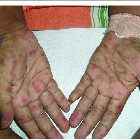 Generalized Erythematous Rash Extending To Palms And Soles Download
