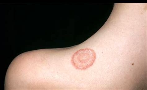 At least 9 it depends if you bleach it or not and what volume of bleach and what type of dye you put in your hair. Does ringworm itch? Images, Symptoms, Causes, Treatment