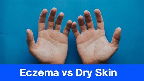 Eczema Vs Dry Skin What Are The Differences And How To Tell Them Apart