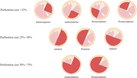Classification Of Tympanic Membrane Perforation Site According To Size