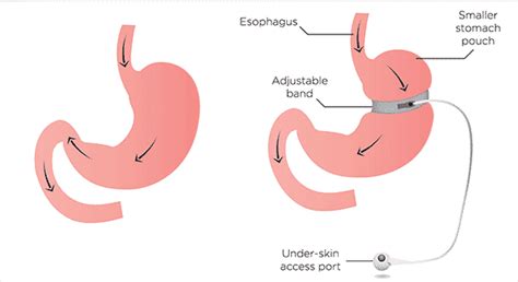 A Guide To Different Types Of Bariatric Surgeries Performed