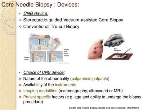 Core Needle Biopsy Of Breast Updates