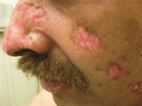 Discoid Lupus Multiple Discoid Plaques With Central Scarring And