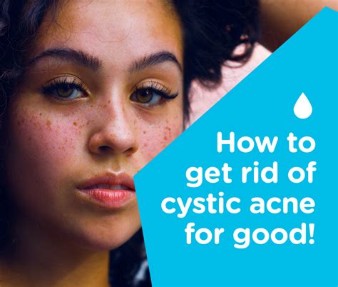 The Truth About Cystic Acne And How You Can Finally Get Rid Of It