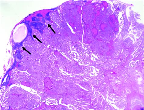 Low Magnification Shows Metastatic Papillary Carcinoma Of Lymph Node