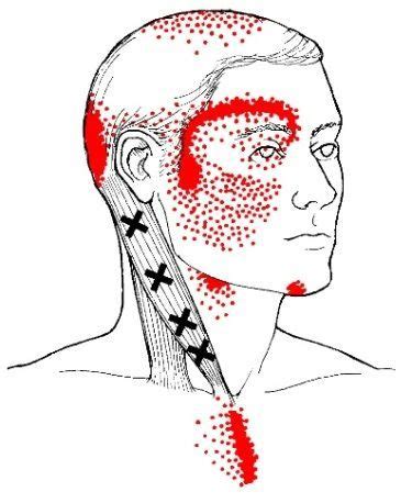 Sternocleidomastoid Muscle Location Action And Trigger Points
