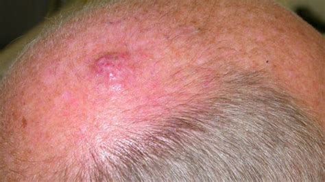 Merkel cell carcinoma most commonly affects regions of the skin that are exposed to the sun including the head/neck and arms. Merkel Cell Carcinoma | lethal skin cancer detected in WA