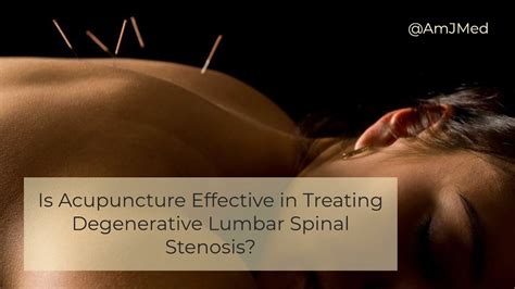 Is Acupuncture Effective In Treating Low Back Pain Youtube