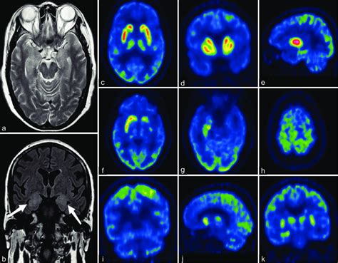 A And B Brain Magnetic Resonance Imaging Mri Of The Patient A Download Scientific
