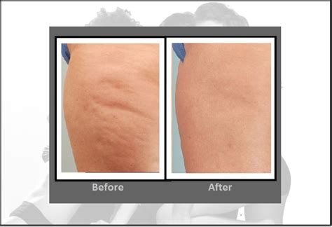 Cellulite Treatment Cellulaze™ Laser Procedure Hartford Ct